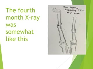 The fourth
month X-ray
was
somewhat
like this
 