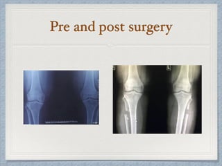 Pre and post surgery
 