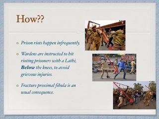How??
Prison riots happen infrequently.
Wardens are instructed to hit
rioting prisoners with a Lathi,
Below the knees, to avoid
grievous injuries.
Fracture proximal fibula is an
usual consequence.
 