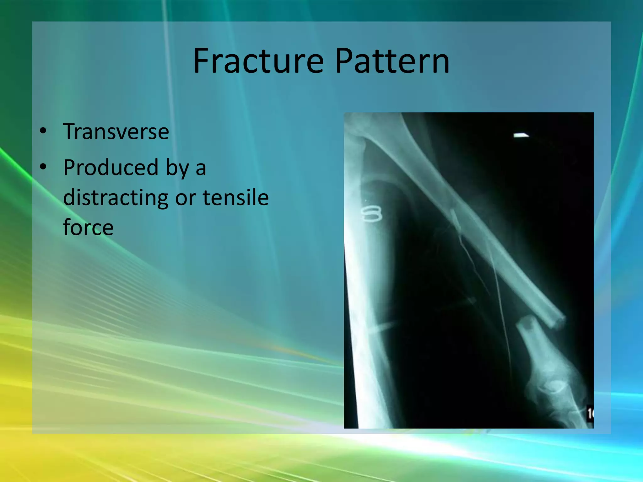 Fracture Pattern
• Transverse
• Produced by a
  distracting or tensile
  force
 