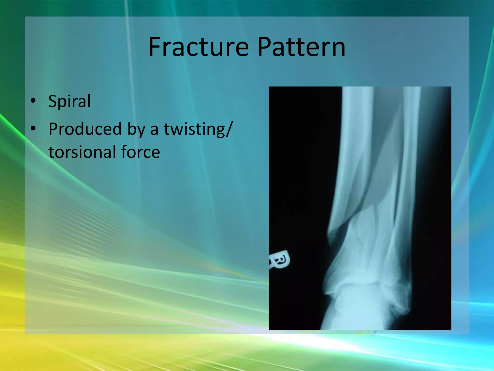 Fracture Pattern
• Spiral
• Produced by a twisting/
  torsional force
 