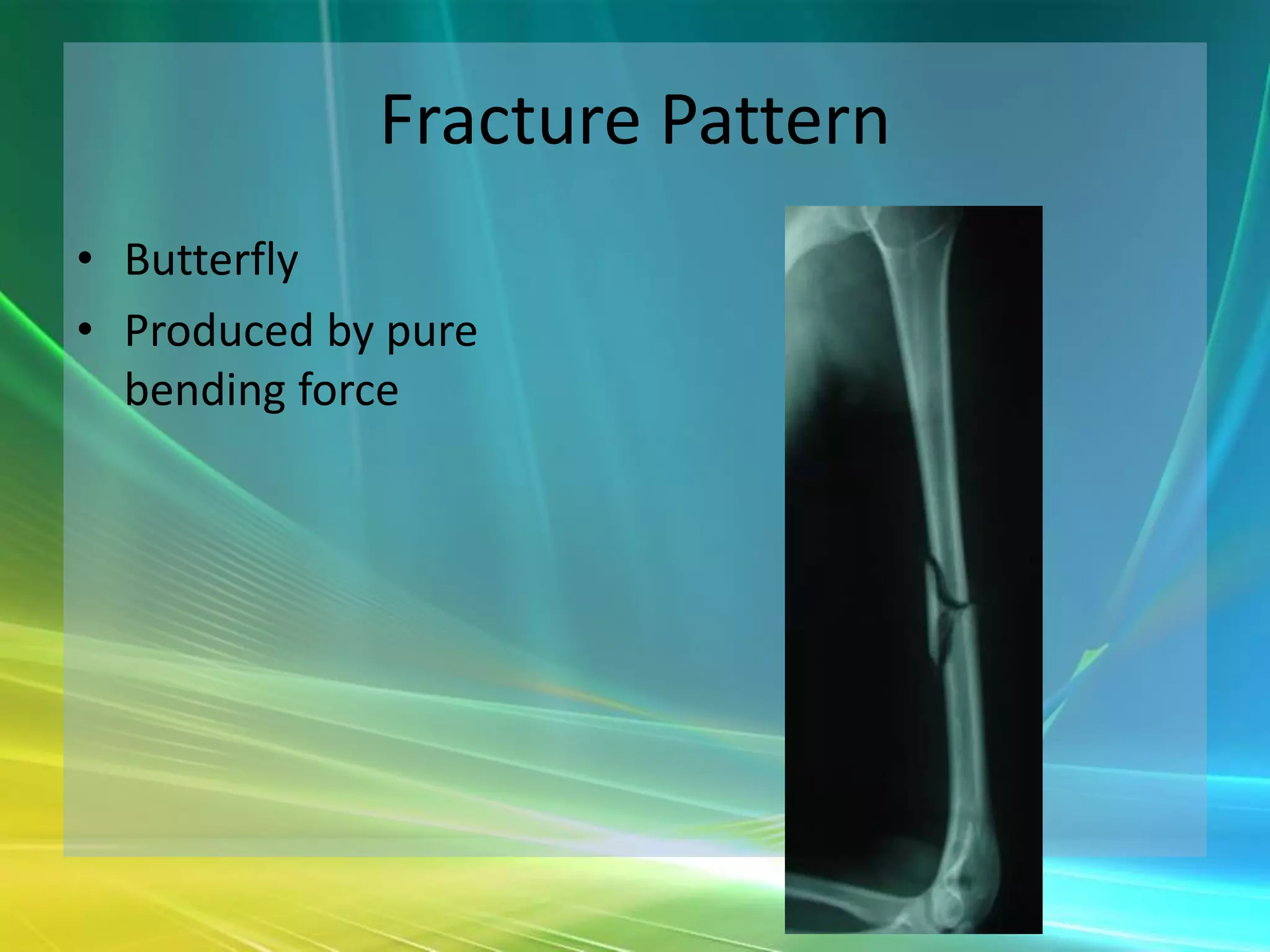 Fracture Pattern
• Butterfly
• Produced by pure
  bending force
 