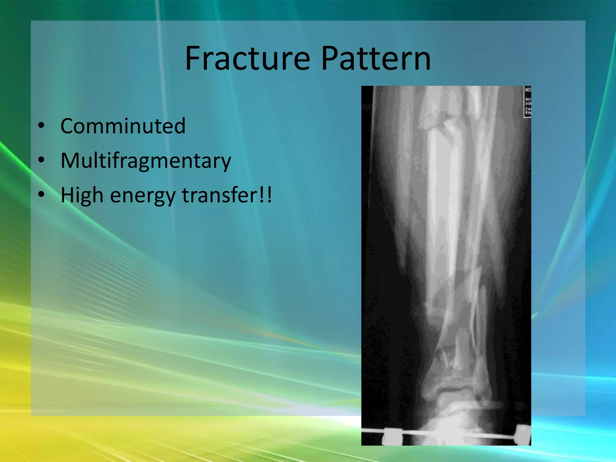 Fracture Pattern
• Comminuted
• Multifragmentary
• High energy transfer!!
 