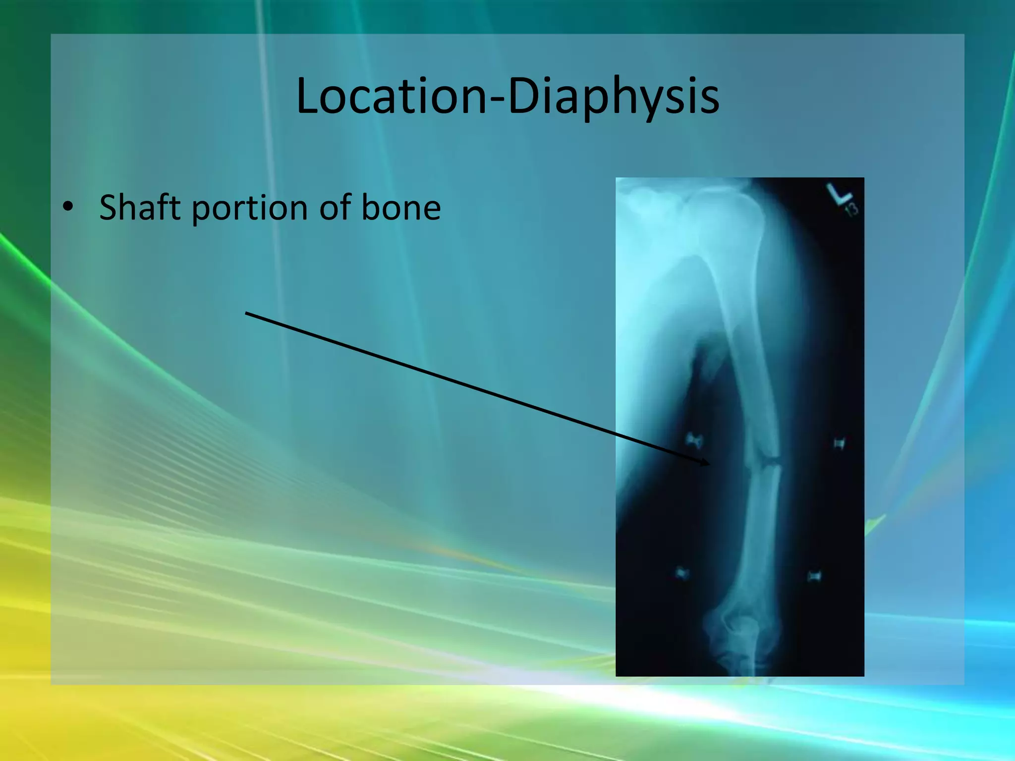 Location-Diaphysis
• Shaft portion of bone
 