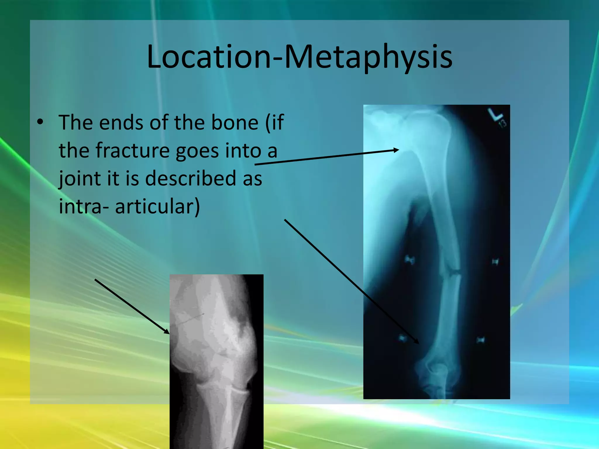 Location-Metaphysis
• The ends of the bone (if
  the fracture goes into a
  joint it is described as
  intra- articular)
 