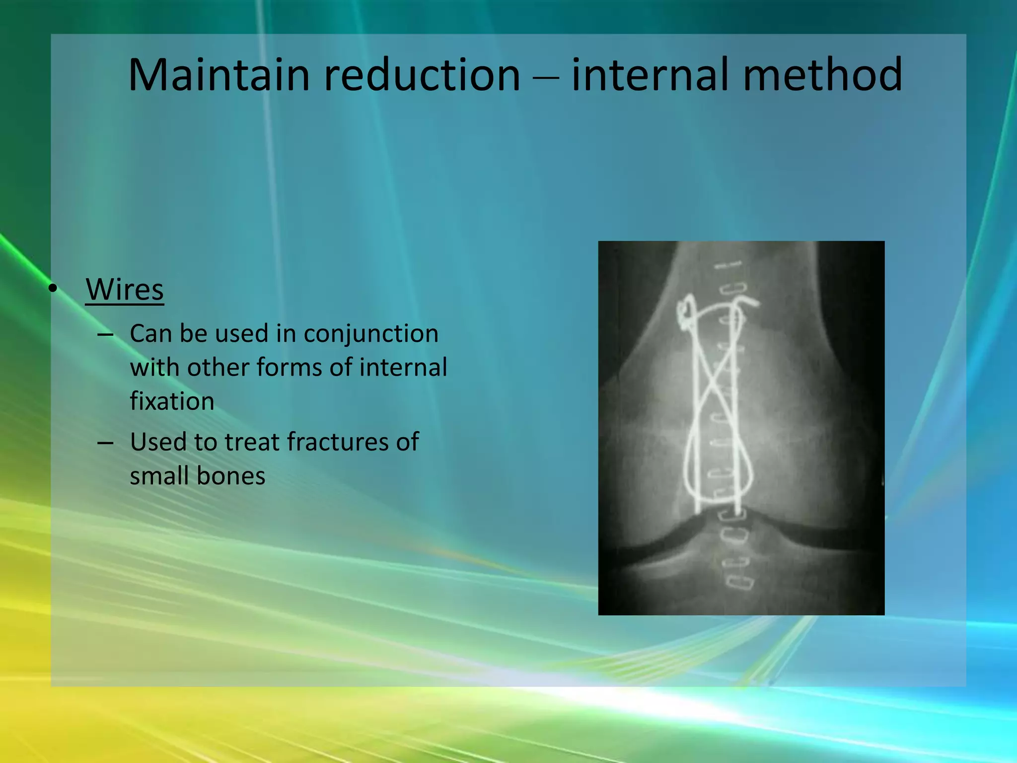 Maintain reduction – internal method



• Wires
   – Can be used in conjunction
     with other forms of internal
     fixation
   – Used to treat fractures of
     small bones
 