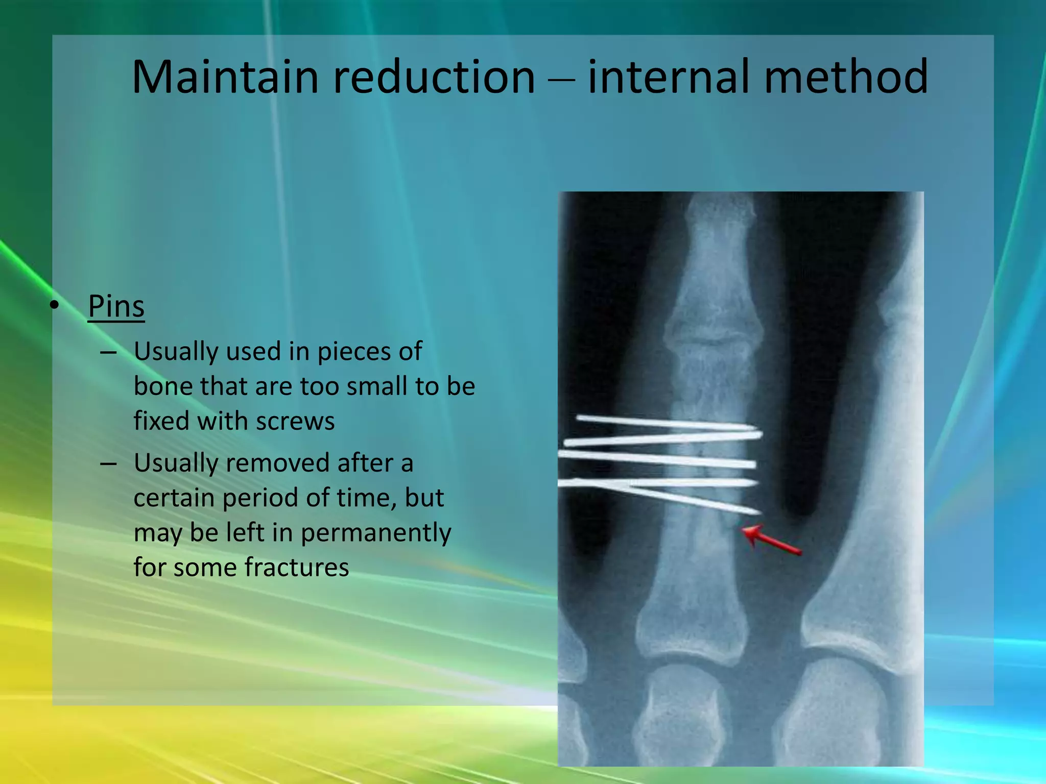 Maintain reduction – internal method



• Pins
   – Usually used in pieces of
     bone that are too small to be
     fixed with screws
   – Usually removed after a
     certain period of time, but
     may be left in permanently
     for some fractures
 
