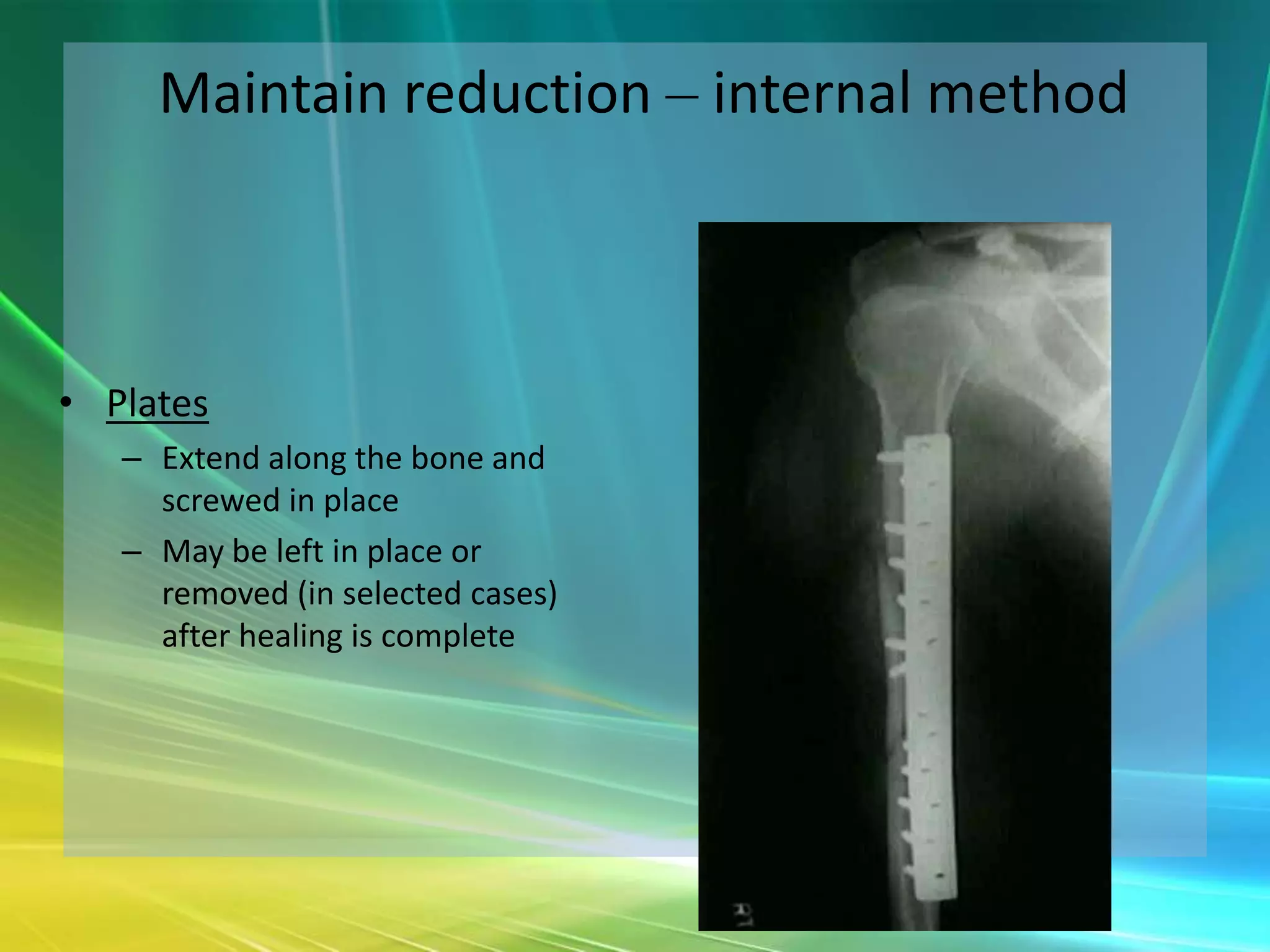 Maintain reduction – internal method



• Plates
   – Extend along the bone and
     screwed in place
   – May be left in place or
     removed (in selected cases)
     after healing is complete
 