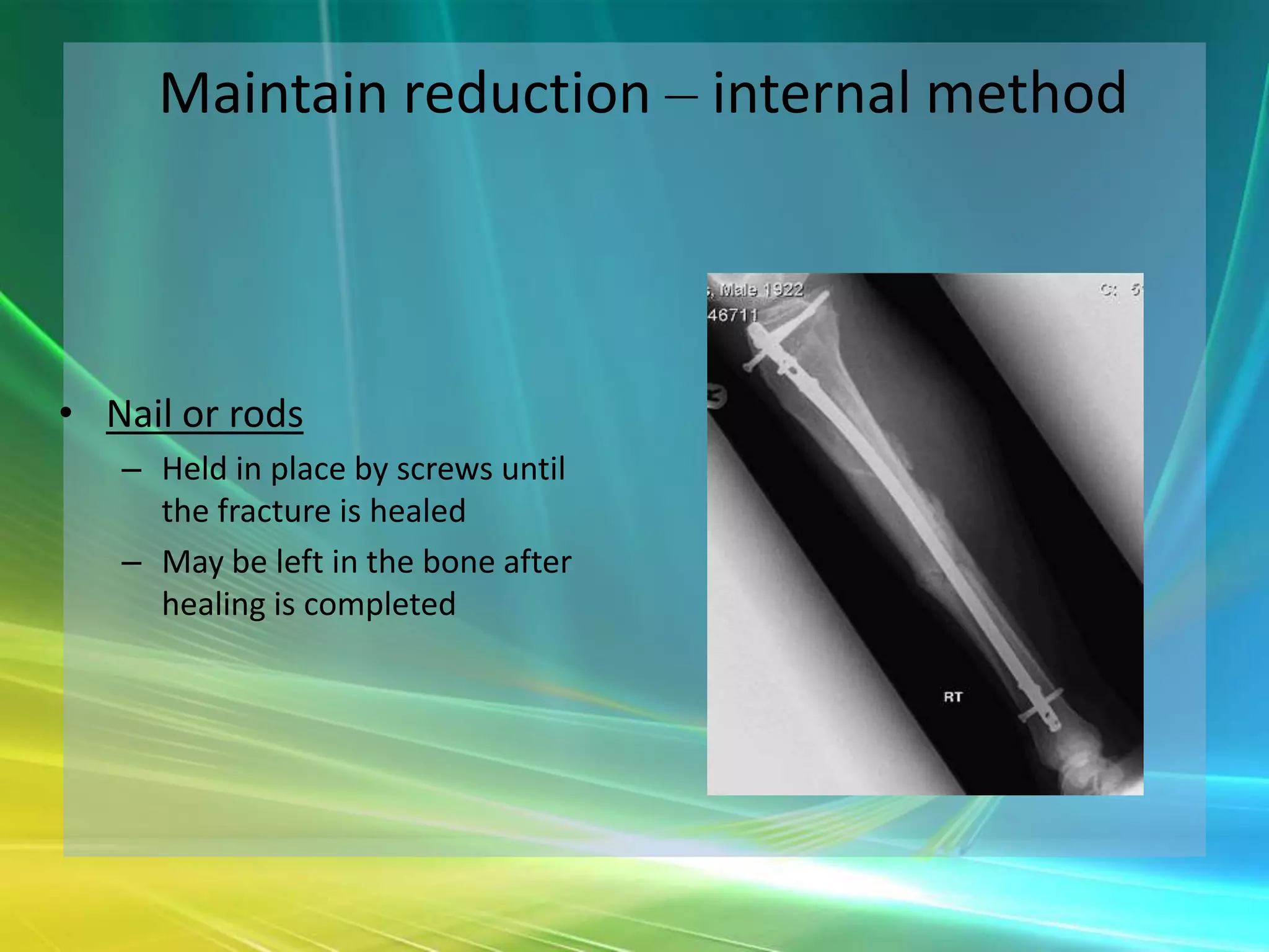 Maintain reduction – internal method



• Nail or rods
   – Held in place by screws until
     the fracture is healed
   – May be left in the bone after
     healing is completed
 
