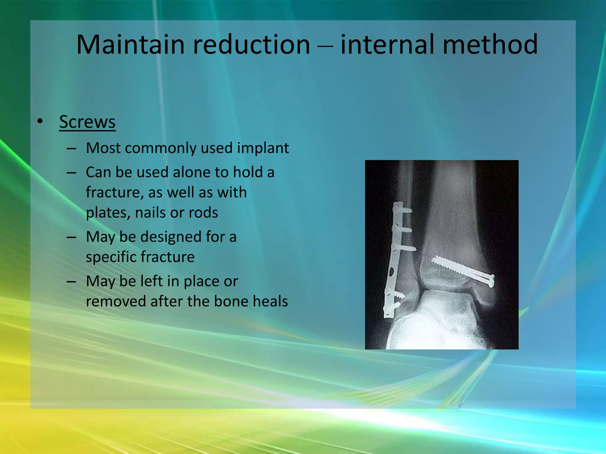 Maintain reduction – internal method

• Screws
   – Most commonly used implant
   – Can be used alone to hold a
     fracture, as well as with
     plates, nails or rods
   – May be designed for a
     specific fracture
   – May be left in place or
     removed after the bone heals
 