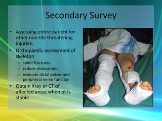 Splinting Skeleton Orthopaedic Trauma - The Basics | PPTX