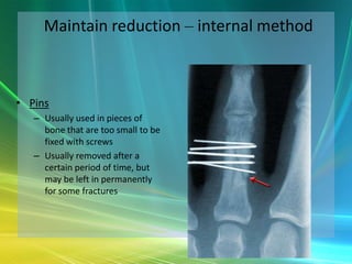 Orthopaedic Trauma - The Basics | PPTX