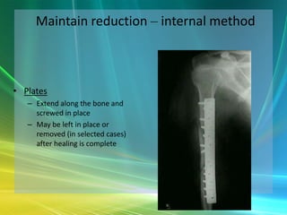 Orthopaedic Trauma - The Basics | PPTX