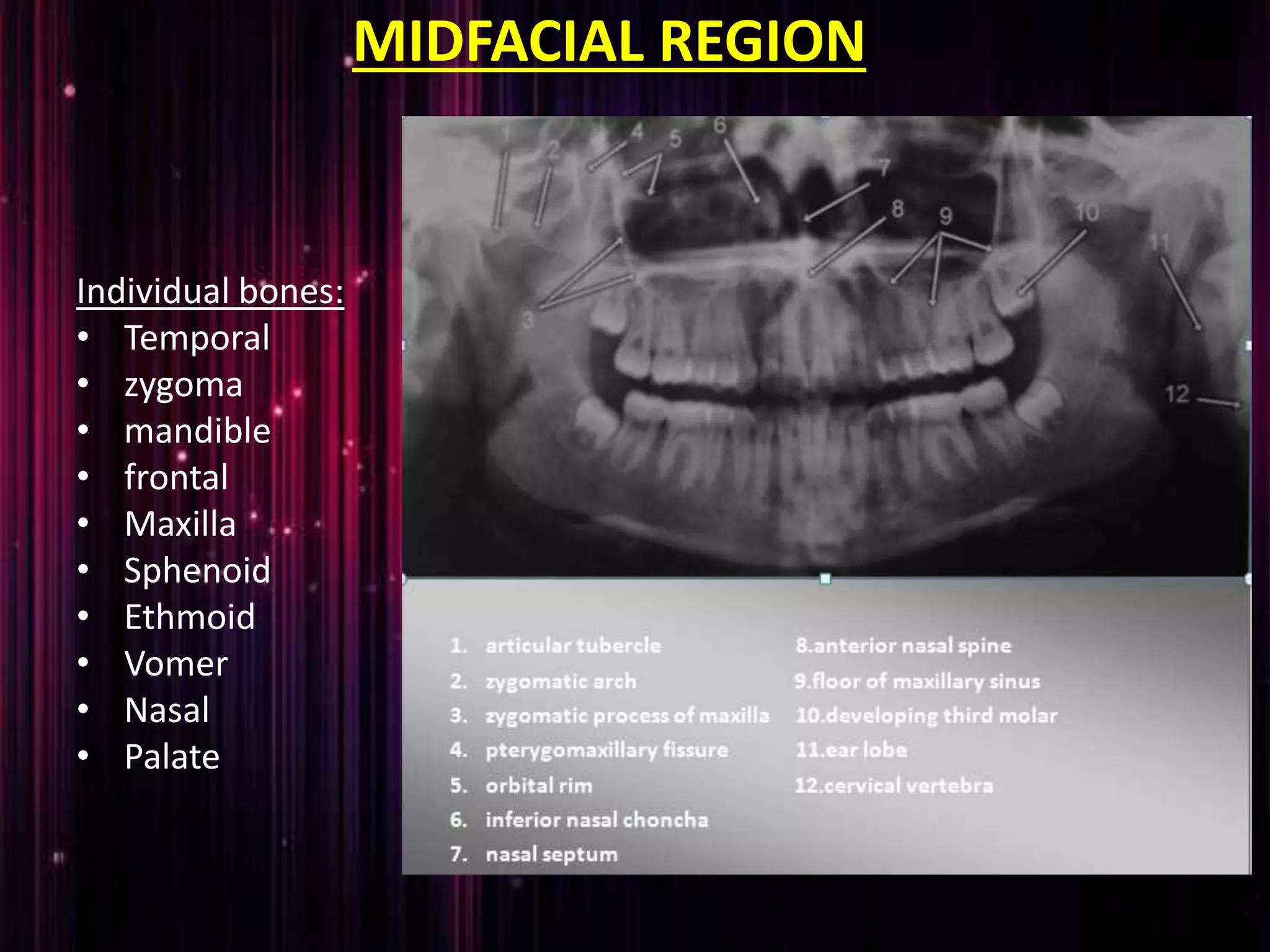 MIDFACIAL REGION
Individual bones:
• Temporal
• zygoma
• mandible
• frontal
• Maxilla
• Sphenoid
• Ethmoid
• Vomer
• Nasal
• Palate
 