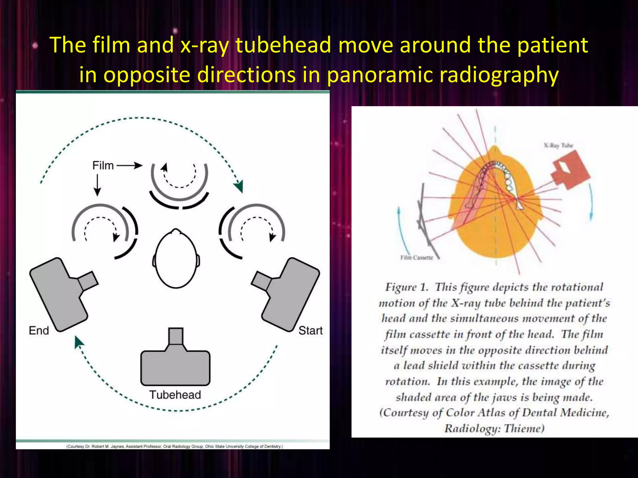 The film and x-ray tubehead move around the patient
in opposite directions in panoramic radiography
 