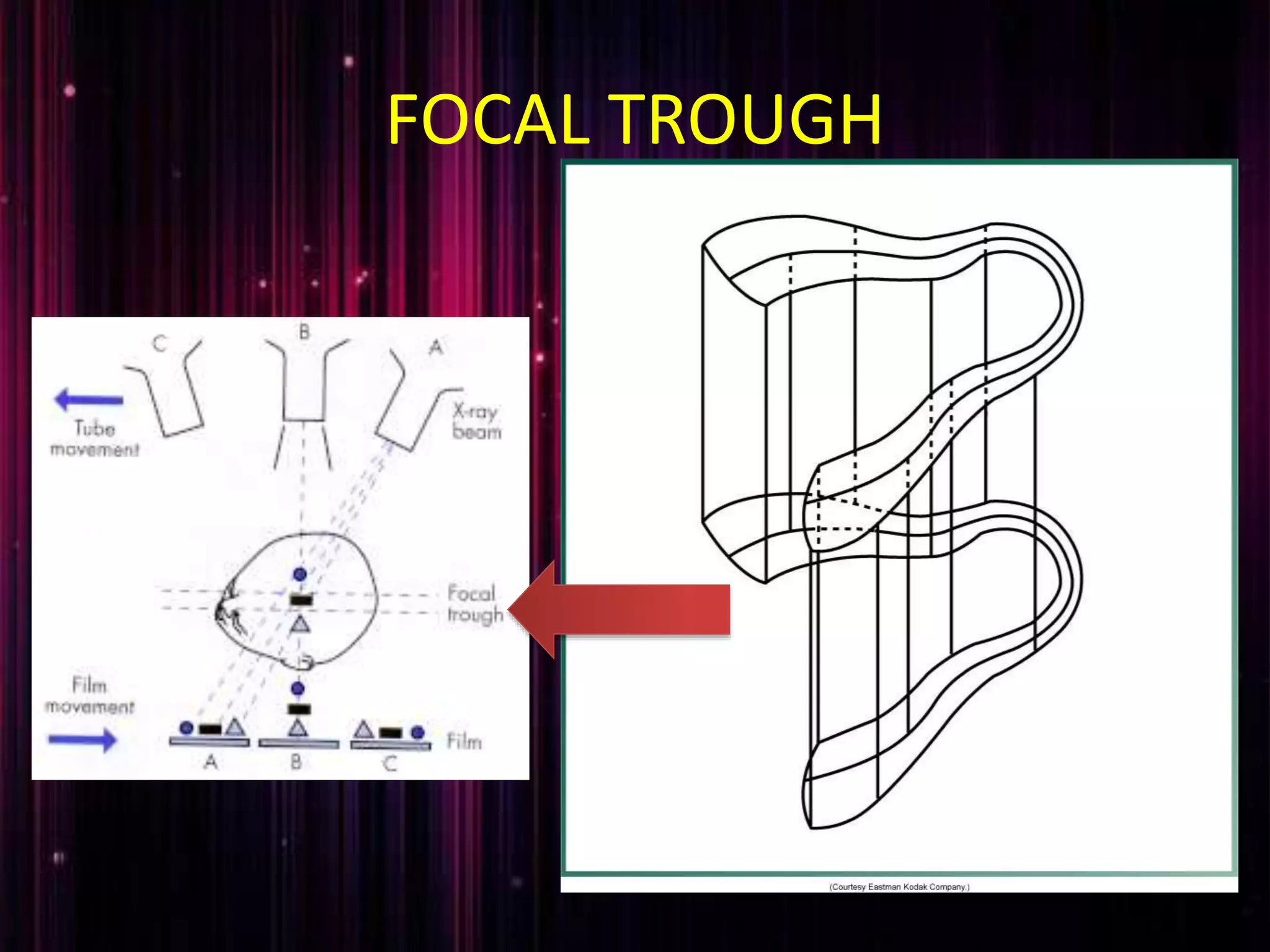 FOCAL TROUGH
 