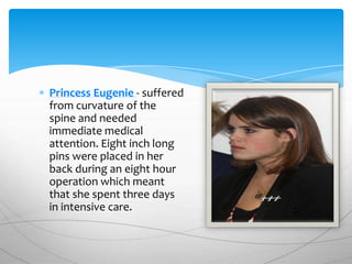 Princess Eugenie - suffered
from curvature of the
spine and needed
immediate medical
attention. Eight inch long
pins were placed in her
back during an eight hour
operation which meant
that she spent three days
in intensive care.
 