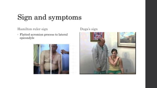 Sign and symptoms
Hamilton ruler sign
• Flatted acromion process to lateral
epicondyle
Duga’s sign
 