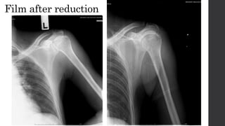 Film after reduction
 