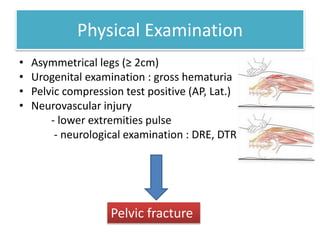 Physical Examination
• Asymmetrical legs (≥ 2cm)
• Urogenital examination : gross hematuria
• Pelvic compression test positive (AP, Lat.)
• Neurovascular injury
- lower extremities pulse
- neurological examination : DRE, DTR
Pelvic fracture
 