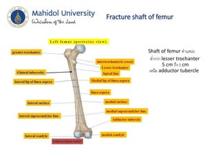 Fracture shaft of femur
• Shaft of femur ตาแหน่ง
• ต่ากว่า lesser trochanter
5 cm ถึง 5 cm
เหนือ adductor tubercle
 