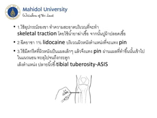 • 1.ใช้อุปกรณ์รองขา ทาความสะอาดบริเวณที่จะทา
skeletal traction โดยใช้น้ายาฆ่าเชื้อ จากนั้นปูผ้าปลอดเชื้อ
• 2.ฉีดยาชา 1% lidocaine บริเวณผิวหนังตาแหน่งที่จะแทง pin
• 3.ใช้มีดกรีดที่ผิวหนังเป็นแผลเล็กๆ แล้วจึงแทง pin ผ่านแผลที่ทาขึ้นนั้นเข้าไป
ในแนวนอน ทะลุไปจนถึงกระดูก
เล็งตาแหน่ง ปลายนิ้วชี้-tibial tuberosity-ASIS
 