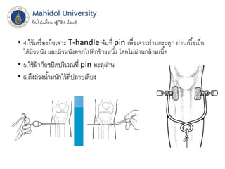 • 4.ใช้เครื่องมือเจาะ T-handle จับที่ pin เพื่อเจาะผ่านกระดูก ผ่านเนื้อเยื่อ
ใต้ผิวหนัง และผิวหนังออกไปอีกข้างหนึ่ง โดยไม่ผ่านกล้ามเนื้อ
• 5.ใช้ผ้าก็อซปิดบริเวณที่ pin ทะลุผ่าน
• 6.ดึงถ่วงน้าหนักไว้ที่ปลายเตียง
 
