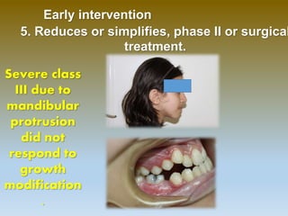 Orthopedic correction of class III | PPTX