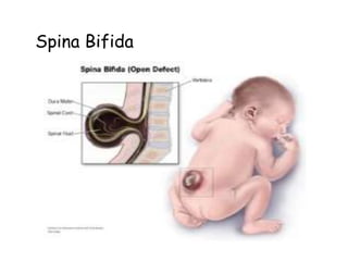 Spina Bifida
 