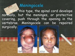 With this type, the spinal cord develops
normally, but the meninges, or protective
covering, push through the opening in the
vertebrae. Meningocele can be repaired
surgically.
Meningocele.
 