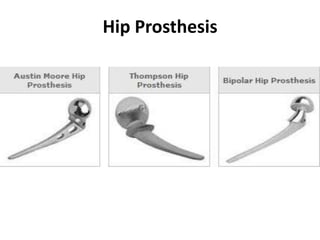 Hip Prosthesis