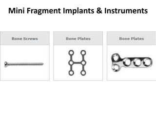 Mini Fragment Implants & Instruments