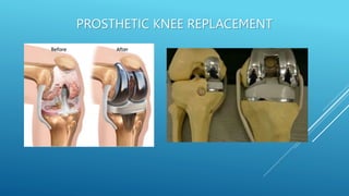 PROSTHETIC KNEE REPLACEMENT
 