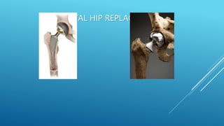TOTAL HIP REPLACEMENT
 