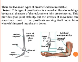 There are two main types of prosthetic devices available:
Linked. This type of prosthesis acts somewhat like a loose hinge
because all the parts of the replacement joint are connected. This
provides good joint stability, but the stresses of movement can
sometimes result in the prosthesis working itself loose from
where it's inserted into the arm bones.
 