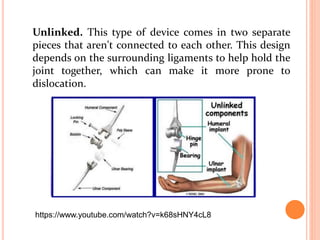 Unlinked. This type of device comes in two separate
pieces that aren't connected to each other. This design
depends on the surrounding ligaments to help hold the
joint together, which can make it more prone to
dislocation.
https://www.youtube.com/watch?v=k68sHNY4cL8
 