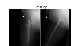 Post Operative String. Sign OrthopedicManagementofOsteoporoticFractures.pptx