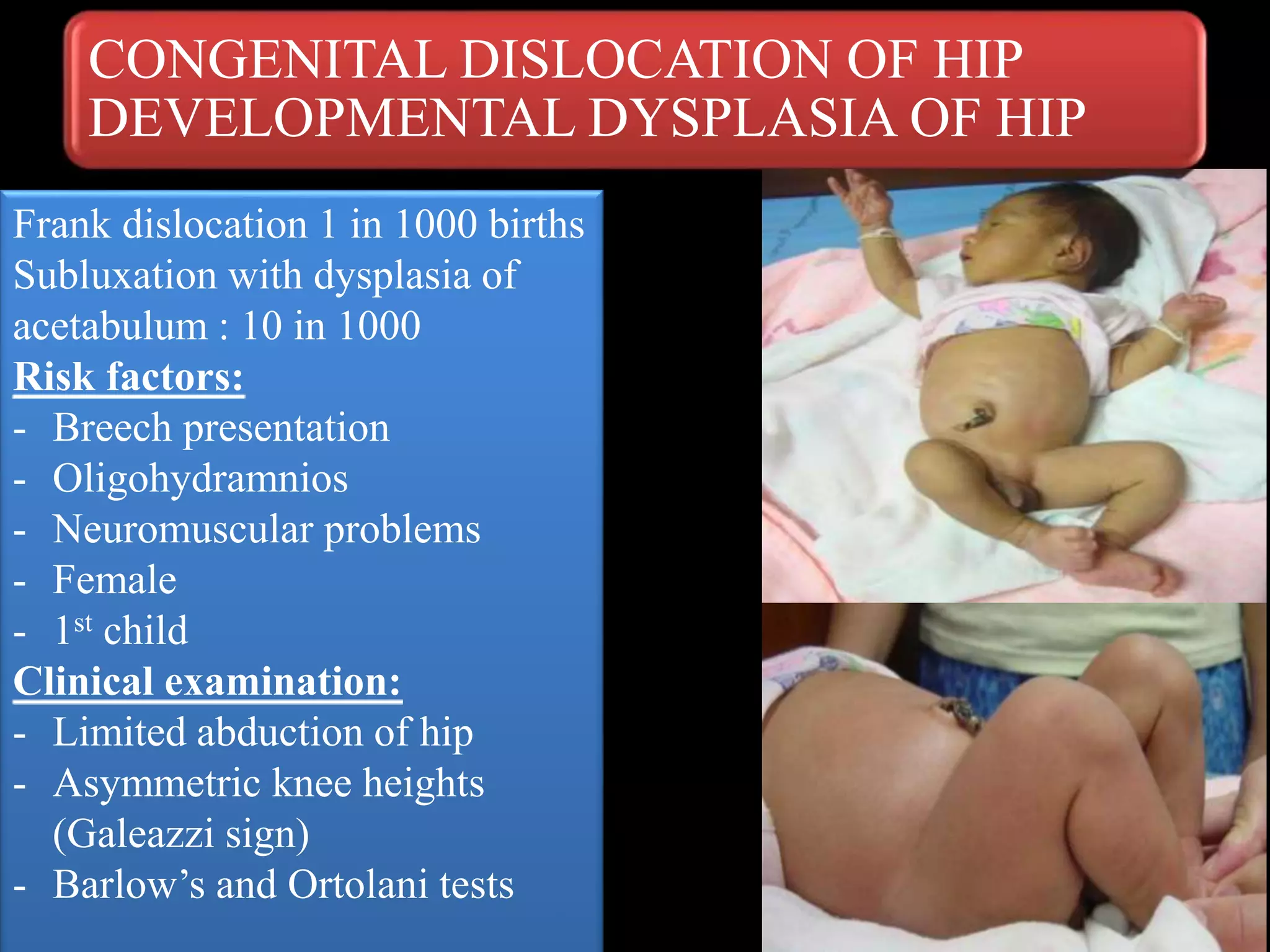 CONGENITAL DISLOCATION OF HIP
DEVELOPMENTAL DYSPLASIA OF HIP
Frank dislocation 1 in 1000 births
Subluxation with dysplasia of
acetabulum : 10 in 1000
Risk factors:
- Breech presentation
- Oligohydramnios
- Neuromuscular problems
- Female
- 1st child
Clinical examination:
- Limited abduction of hip
- Asymmetric knee heights
(Galeazzi sign)
- Barlow’s and Ortolani tests
 