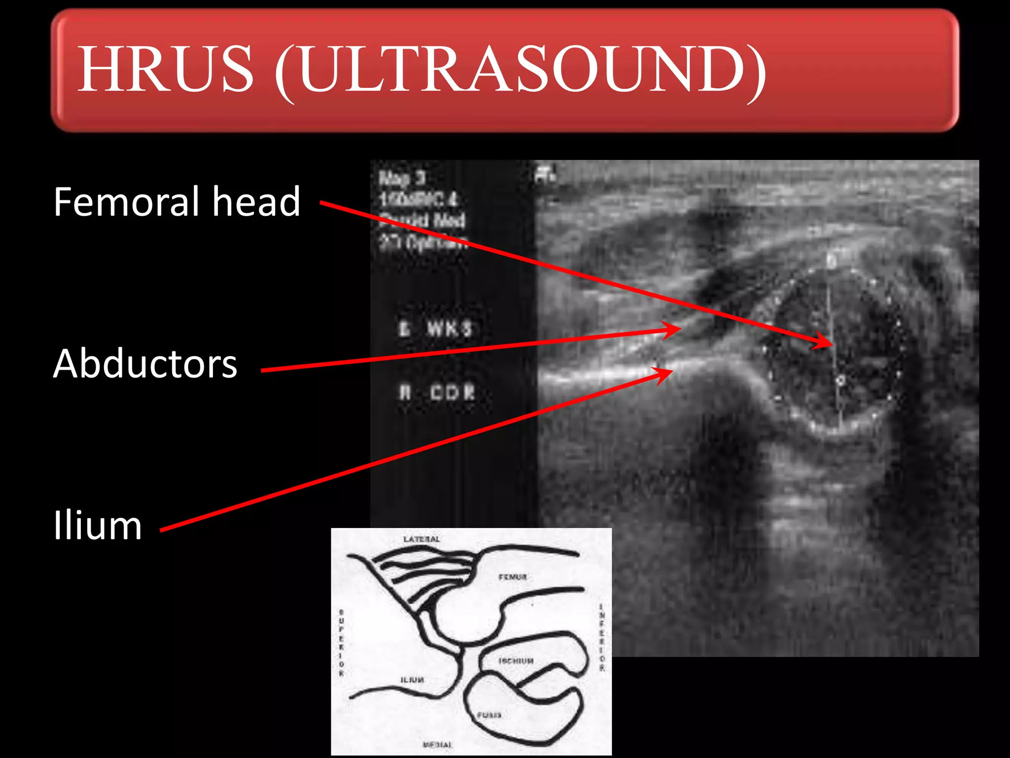 Ultrasound
Femoral head
Abductors
Ilium
HRUS (ULTRASOUND)
 