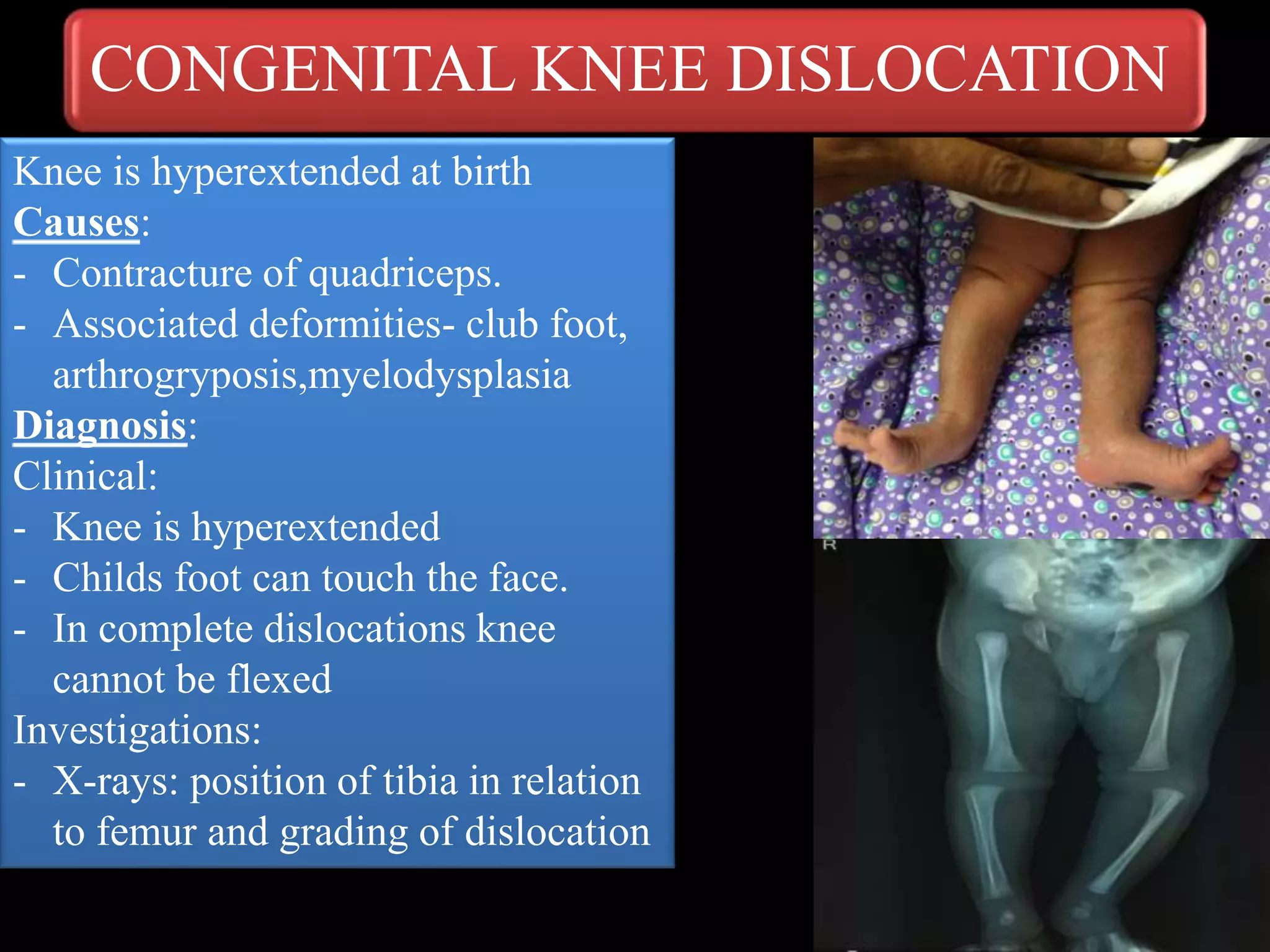 CONGENITAL KNEE DISLOCATION
Knee is hyperextended at birth
Causes:
- Contracture of quadriceps.
- Associated deformities- club foot,
arthrogryposis,myelodysplasia
Diagnosis:
Clinical:
- Knee is hyperextended
- Childs foot can touch the face.
- In complete dislocations knee
cannot be flexed
Investigations:
- X-rays: position of tibia in relation
to femur and grading of dislocation
 