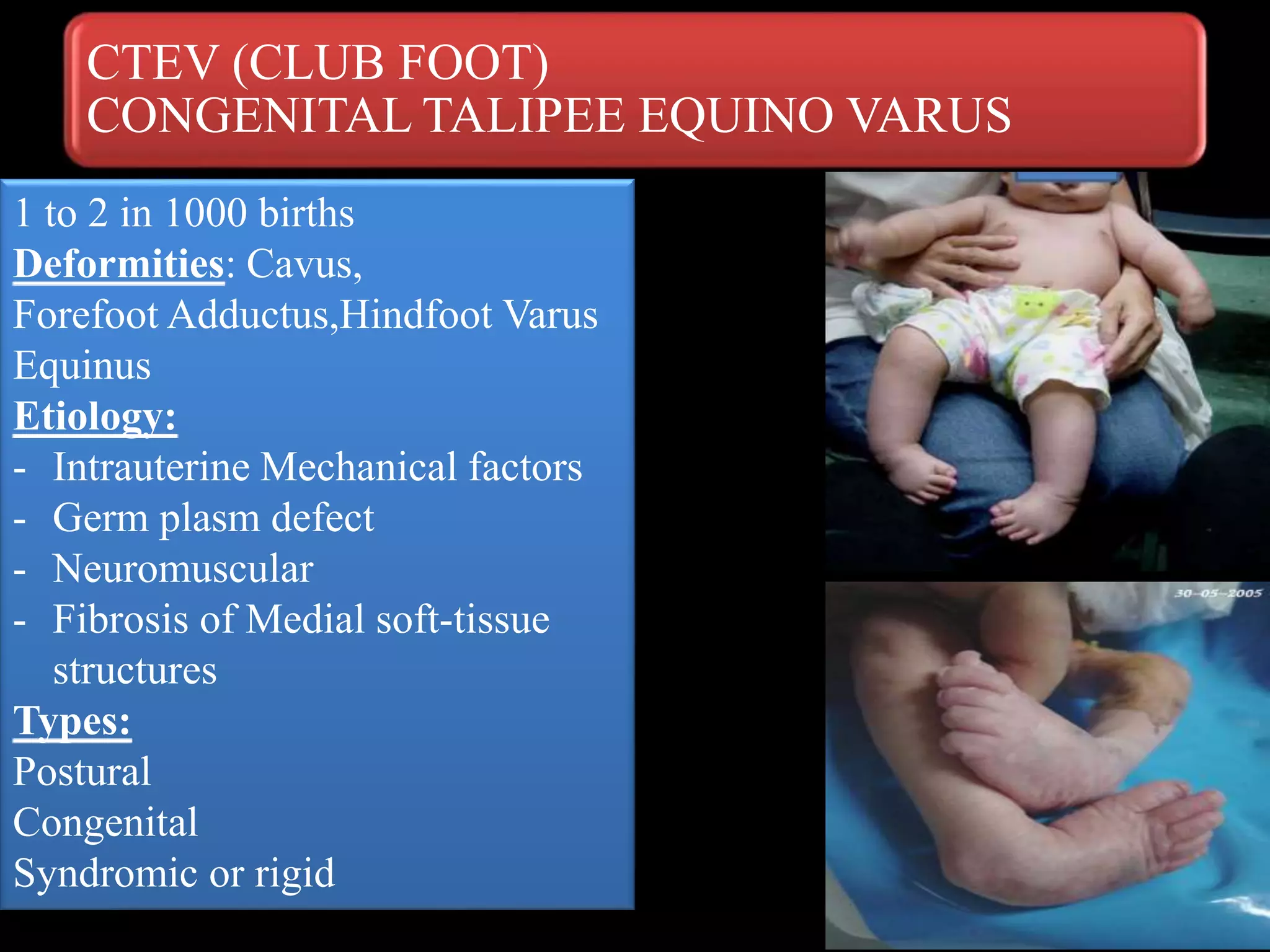 CTEV (CLUB FOOT)
CONGENITAL TALIPEE EQUINO VARUS
1 to 2 in 1000 births
Deformities: Cavus,
Forefoot Adductus,Hindfoot Varus
Equinus
Etiology:
- Intrauterine Mechanical factors
- Germ plasm defect
- Neuromuscular
- Fibrosis of Medial soft-tissue
structures
Types:
Postural
Congenital
Syndromic or rigid
 