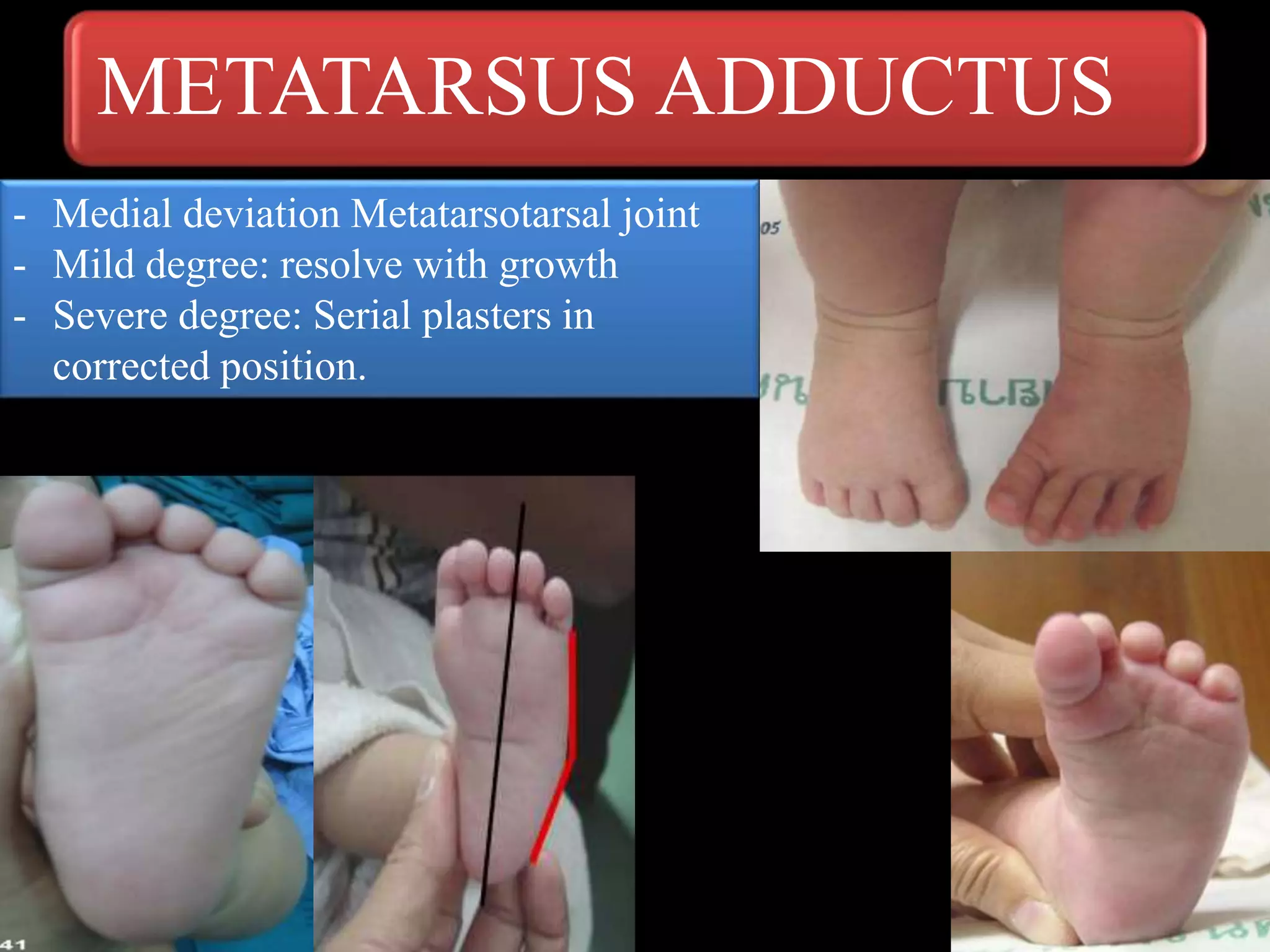 METATARSUS ADDUCTUS
- Medial deviation Metatarsotarsal joint
- Mild degree: resolve with growth
- Severe degree: Serial plasters in
corrected position.
 