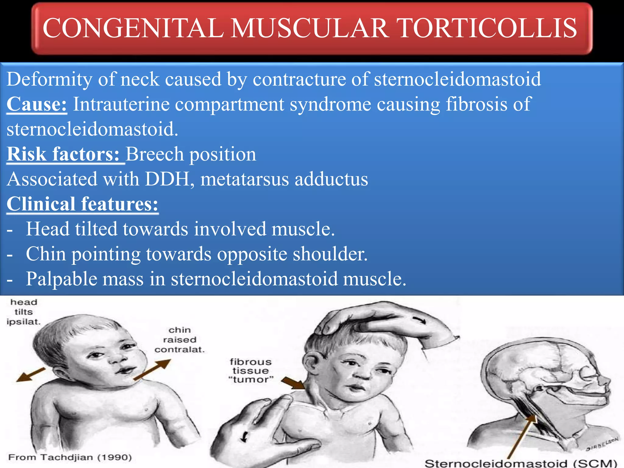 CONGENITAL MUSCULAR TORTICOLLIS
Deformity of neck caused by contracture of sternocleidomastoid
Cause: Intrauterine compartment syndrome causing fibrosis of
sternocleidomastoid.
Risk factors: Breech position
Associated with DDH, metatarsus adductus
Clinical features:
- Head tilted towards involved muscle.
- Chin pointing towards opposite shoulder.
- Palpable mass in sternocleidomastoid muscle.
 