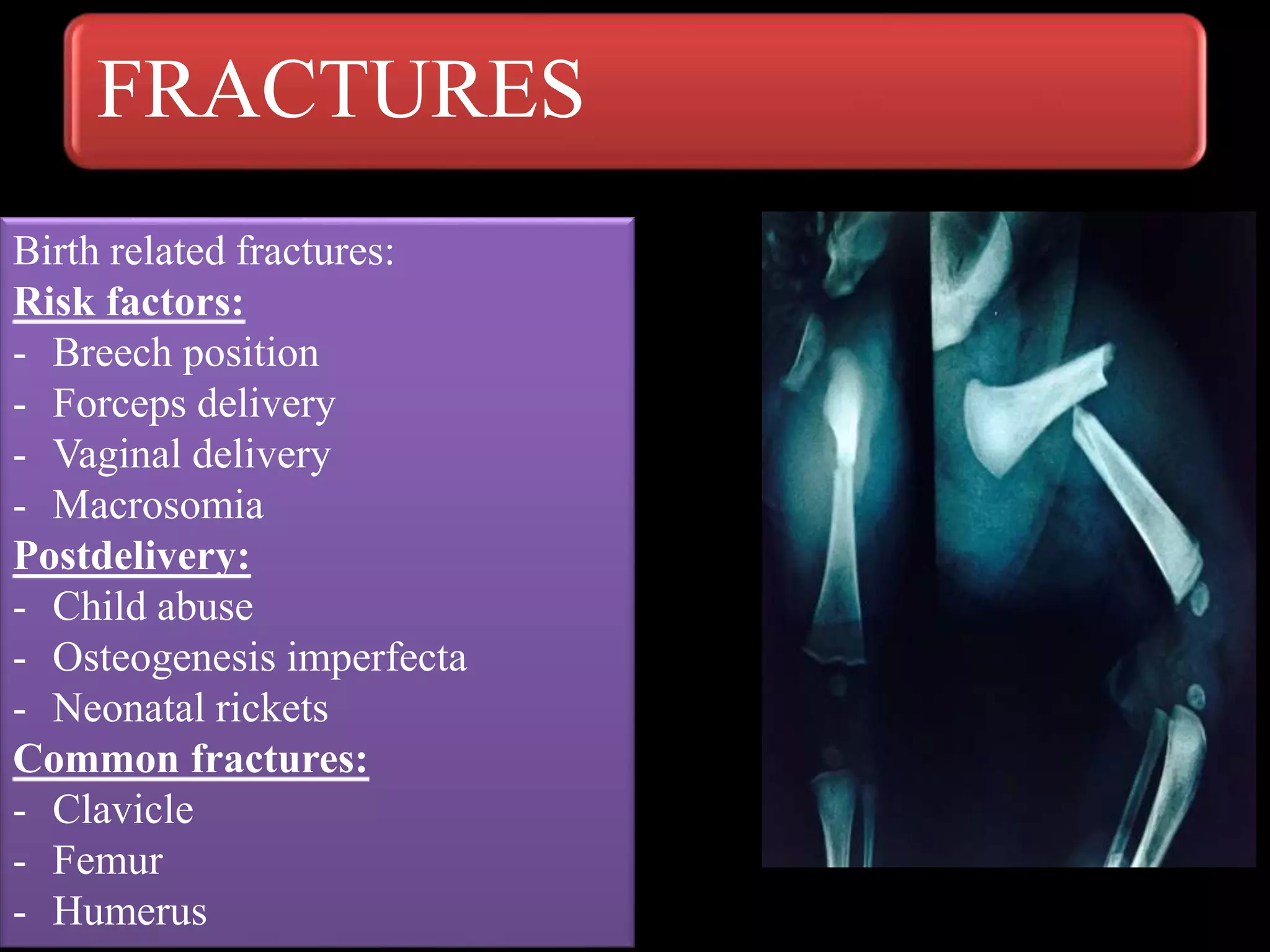 FRACTURES
Birth related fractures:
Risk factors:
- Breech position
- Forceps delivery
- Vaginal delivery
- Macrosomia
Postdelivery:
- Child abuse
- Osteogenesis imperfecta
- Neonatal rickets
Common fractures:
- Clavicle
- Femur
- Humerus
 