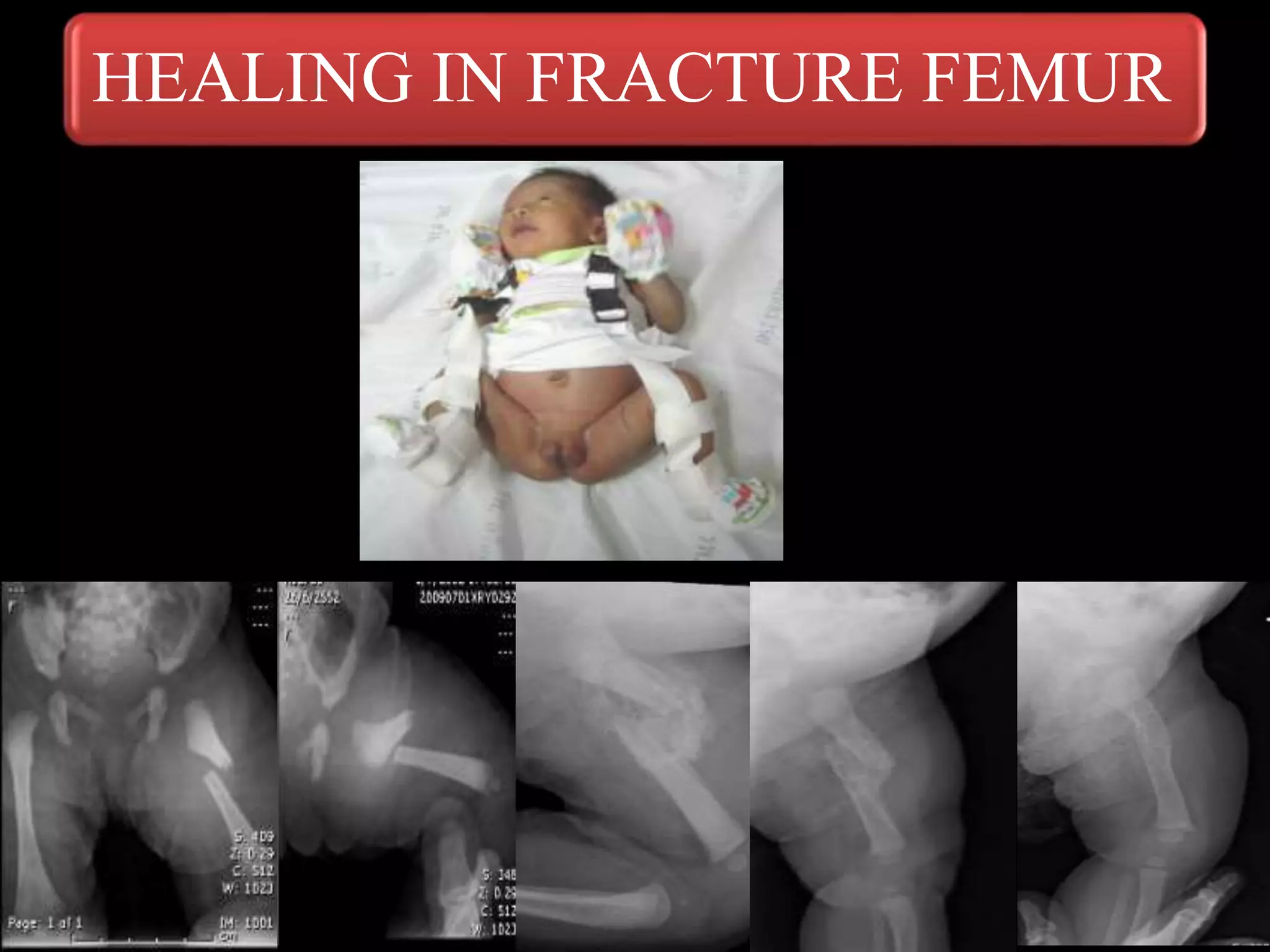 HEALING IN FRACTURE FEMUR
 