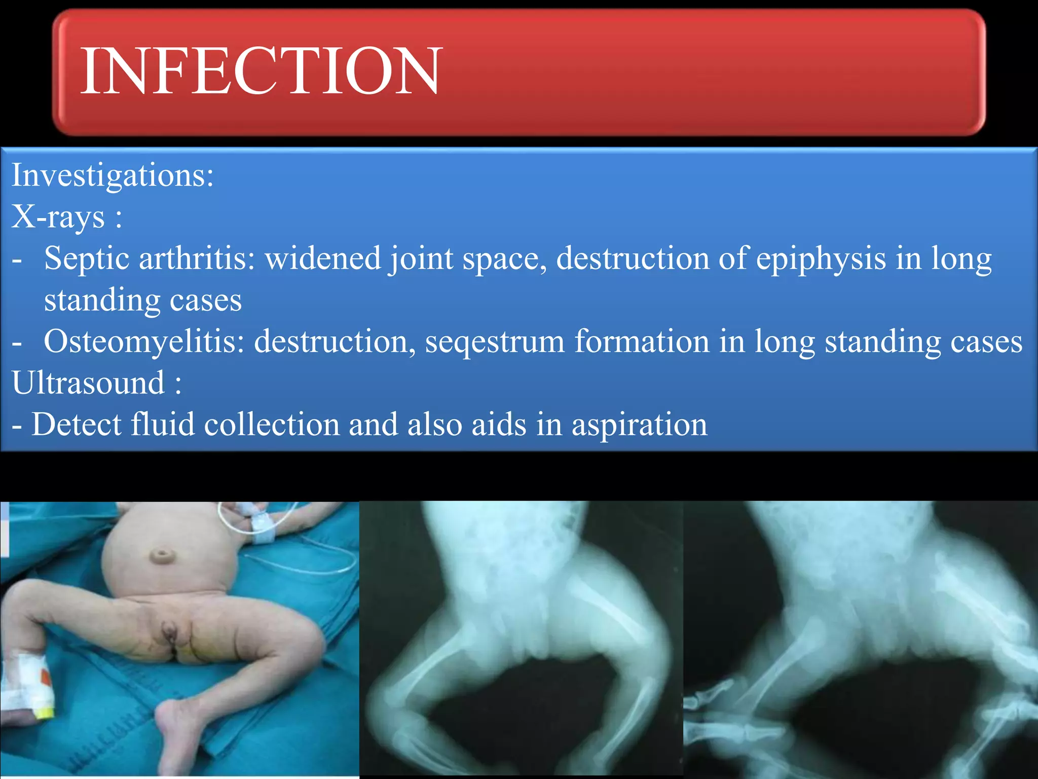 INFECTION
Investigations:
X-rays :
- Septic arthritis: widened joint space, destruction of epiphysis in long
standing cases
- Osteomyelitis: destruction, seqestrum formation in long standing cases
Ultrasound :
- Detect fluid collection and also aids in aspiration
 