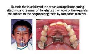 Maxilla Rotation Device Orthopedic protraction of the maxilla part 1 | PPTX