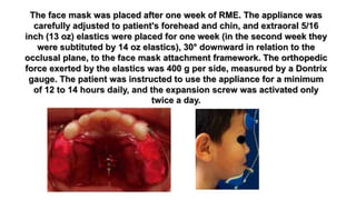 Face Mask Rme Orthopedic protraction of the maxilla part 1 | PPTX