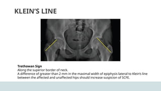 Orthopedics cnditicons commonly seen in childhood | PPTX