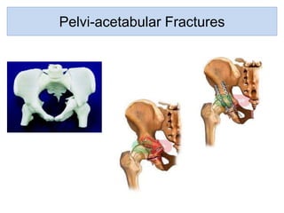 Pelvi-acetabular Fractures : 2015-16
0100 #REF!
Emergency
external fixation
Combined
approaches
Percutaneous
fixation
Tota...